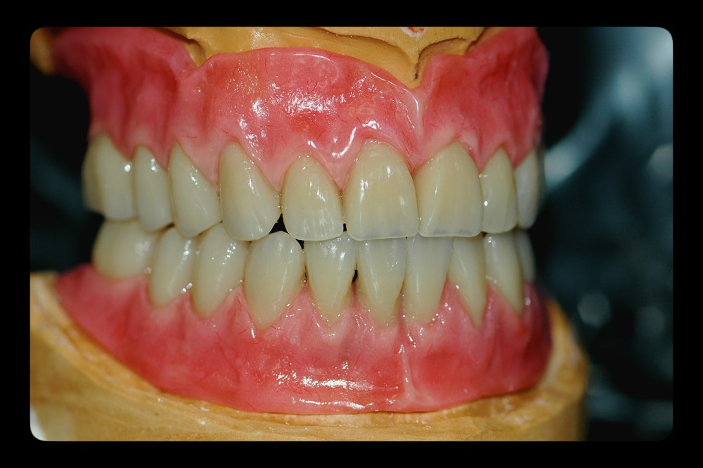 Upper And Lower Partial Dentures Porterdale GA 30070